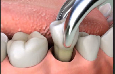 tool removing a tooth