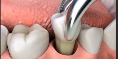 tool removing a tooth